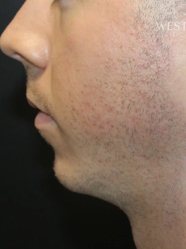 Chin Implant Before & After