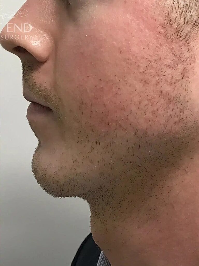 Chin Implant Before & After
