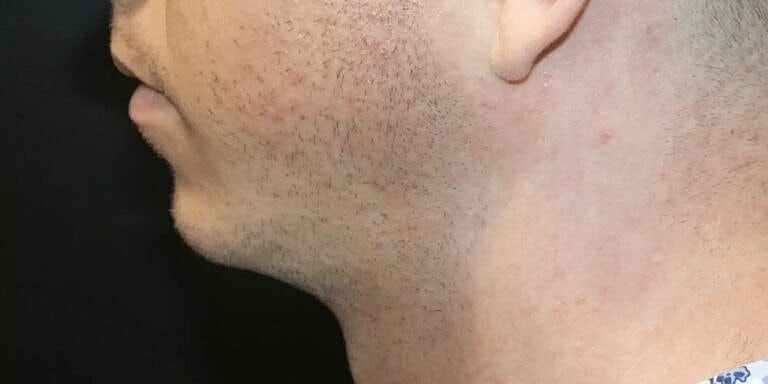 Chin Implant Before & After