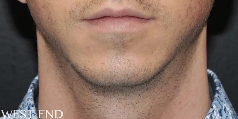 Chin Implant Before & After