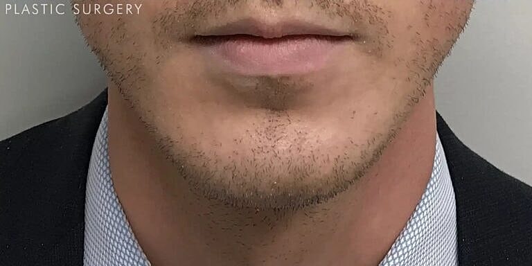 Chin Implant Before & After