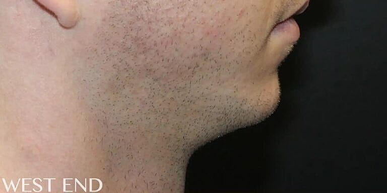 Chin Implant Before & After