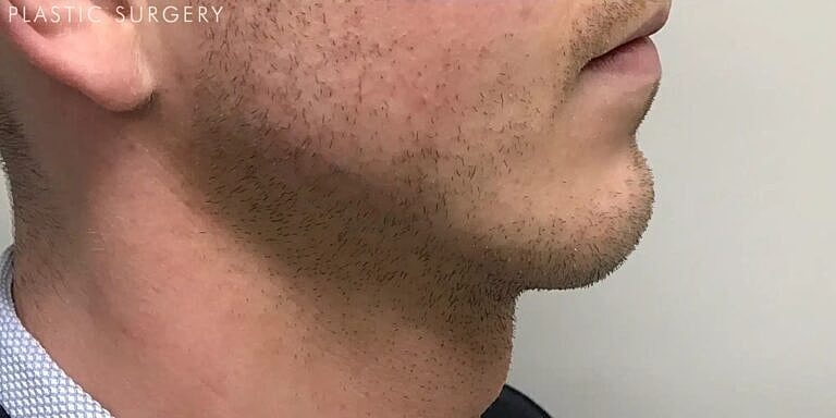 Chin Implant Before & After