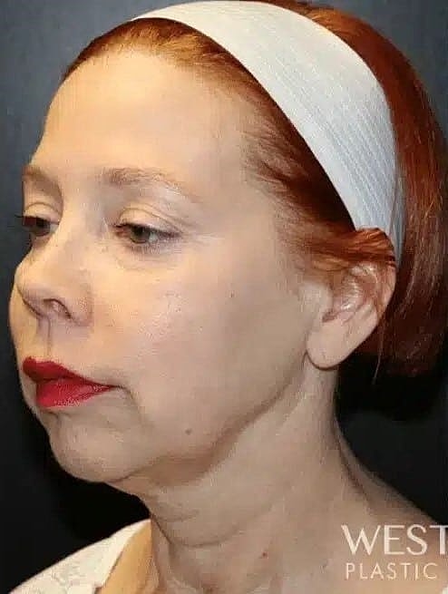 Chin Implant Before & After