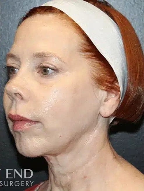 Chin Implant Before & After