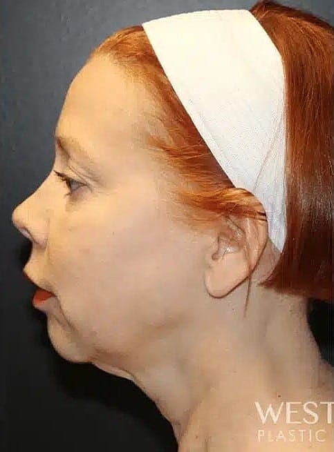 Chin Implant Before & After