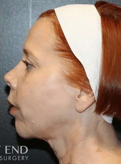 Chin Implant Before & After