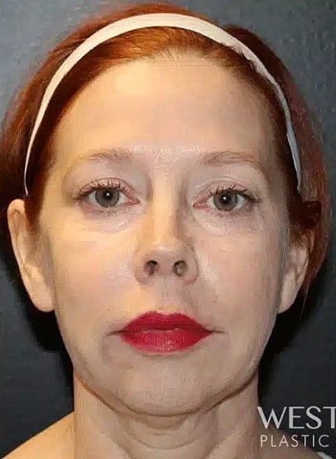 Chin Implant Before & After