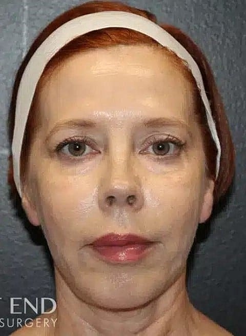 Chin Implant Before & After