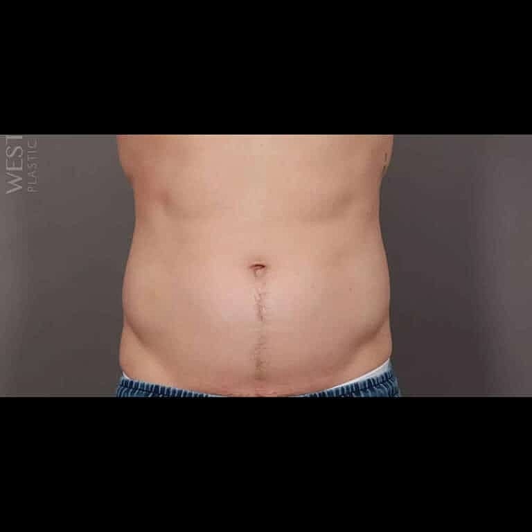 Physiq Before & After