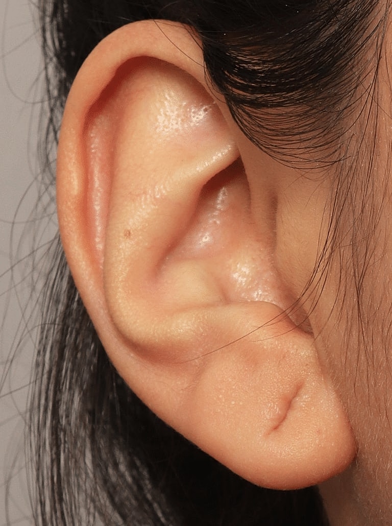 Earlobe Repair Before & After