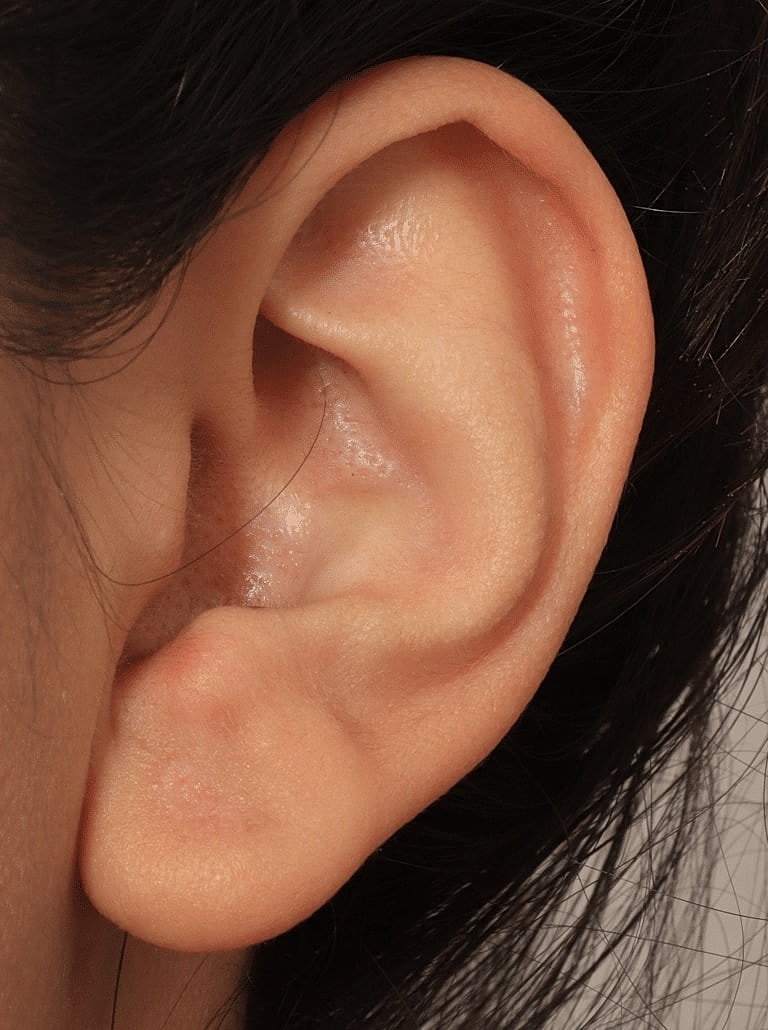 Earlobe Repair Before & After