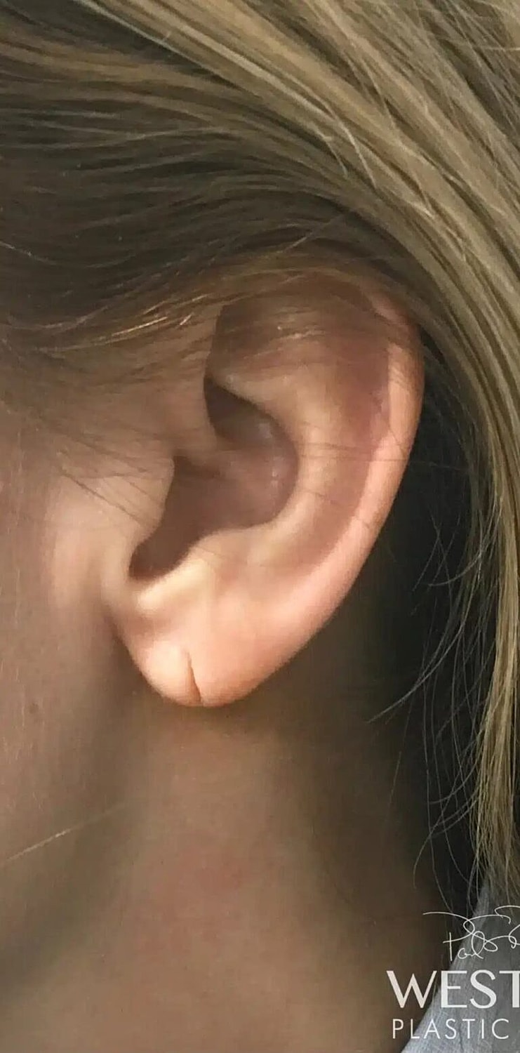 Earlobe Repair Before & After