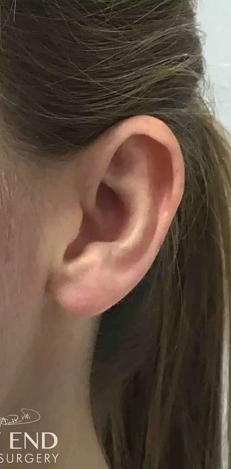 Earlobe Repair Before & After