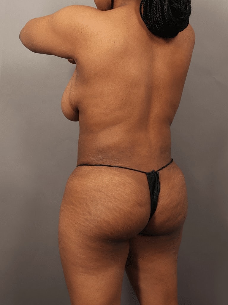 Liposuction Before & After