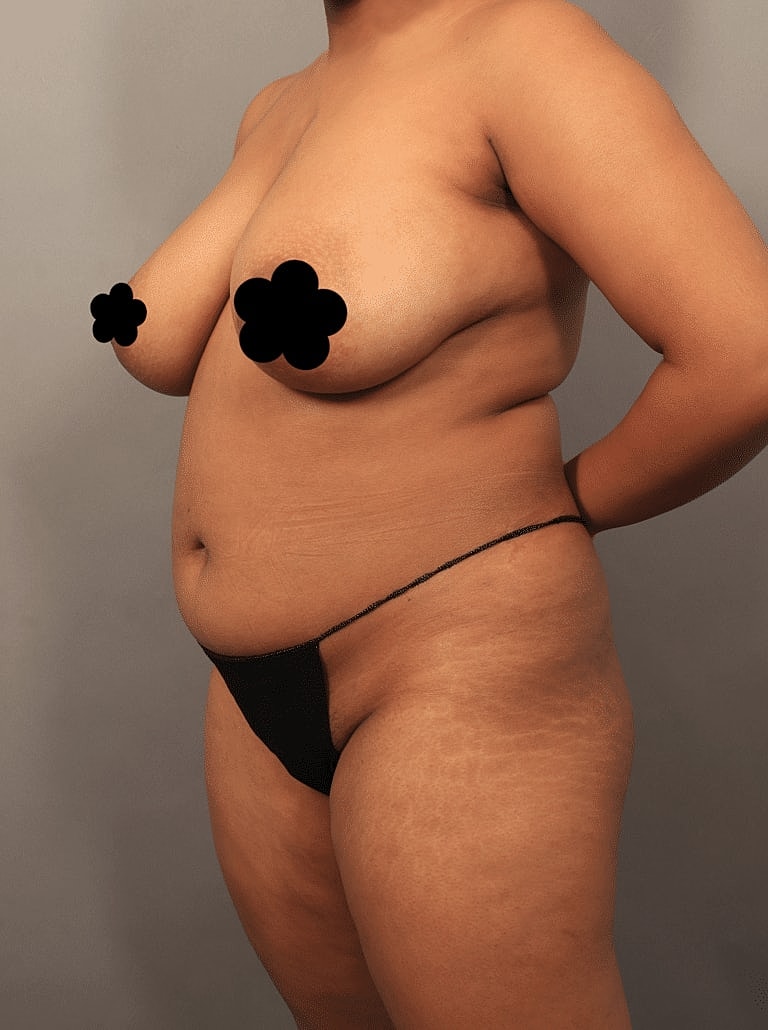 Liposuction Before & After