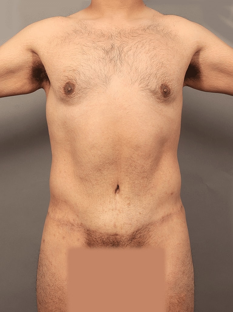 Liposuction Before & After