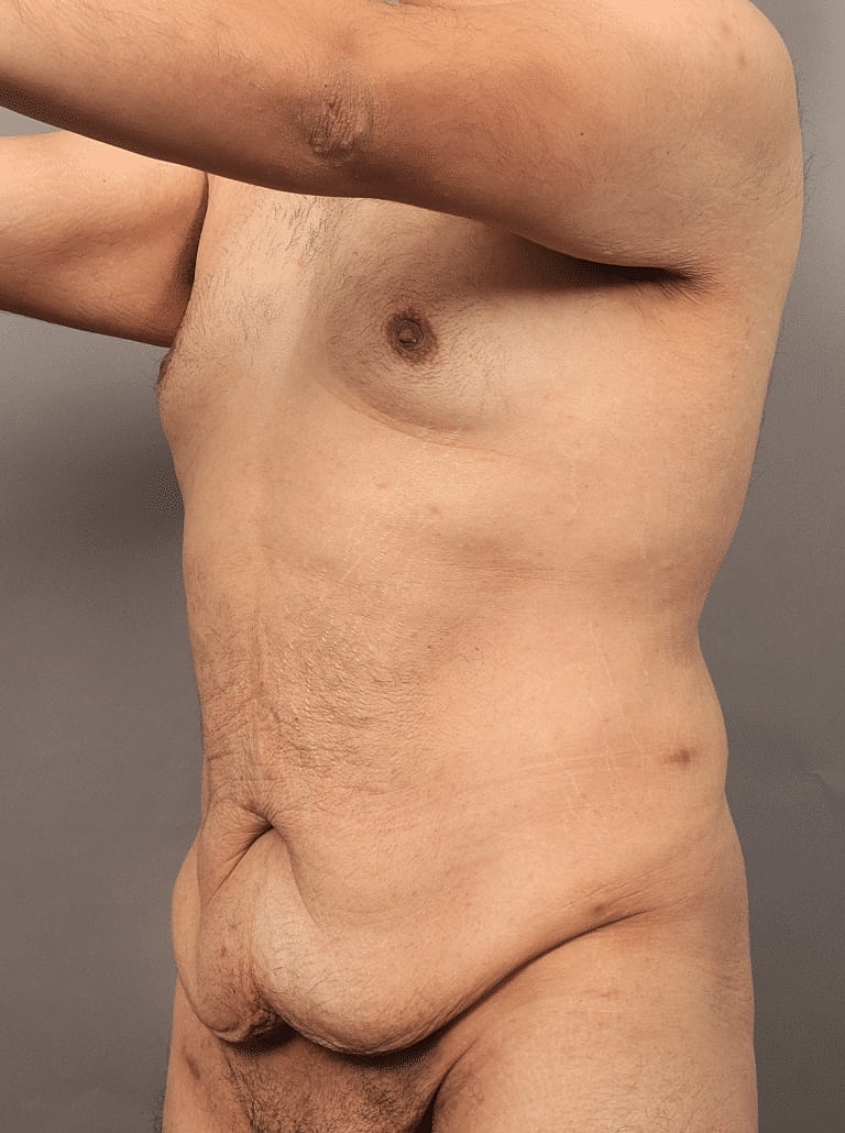 Liposuction Before & After