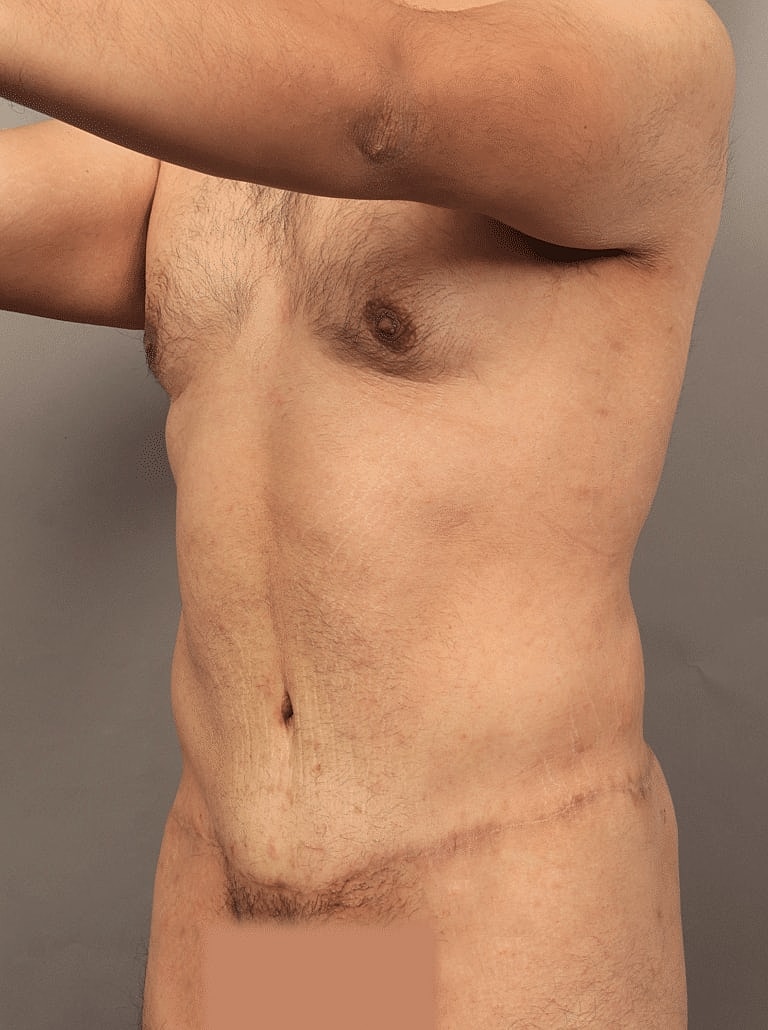 Liposuction Before & After