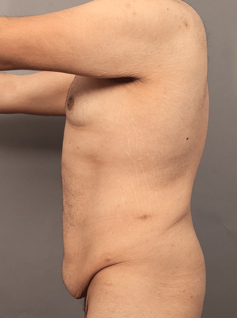 Liposuction Before & After