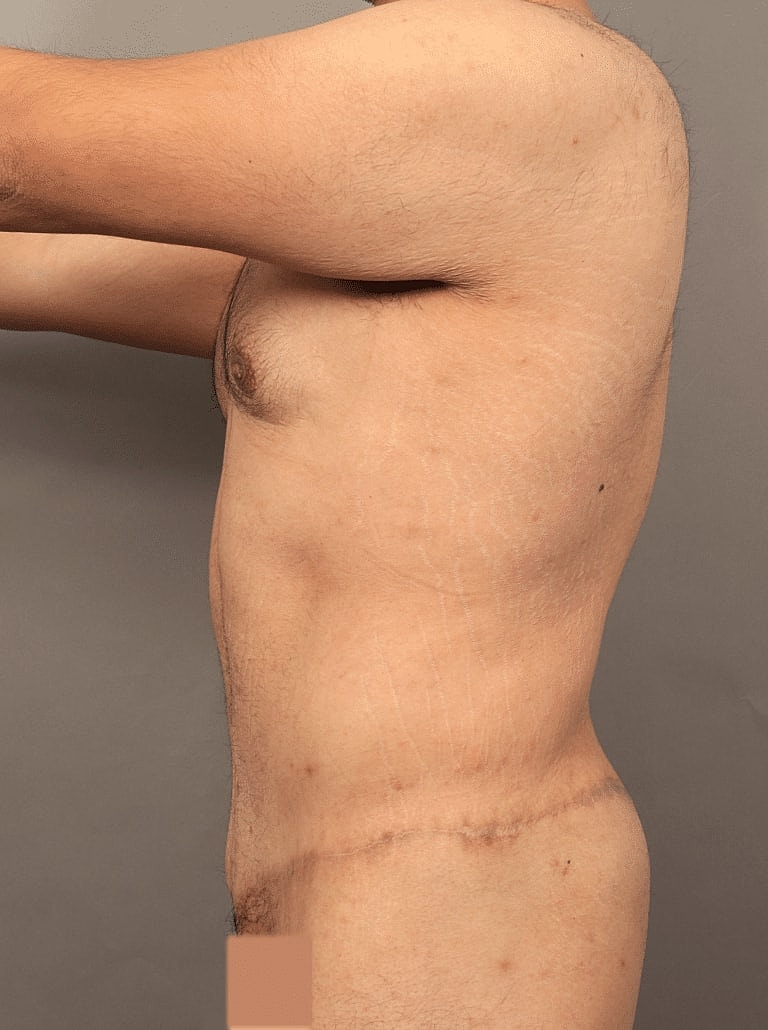 Liposuction Before & After