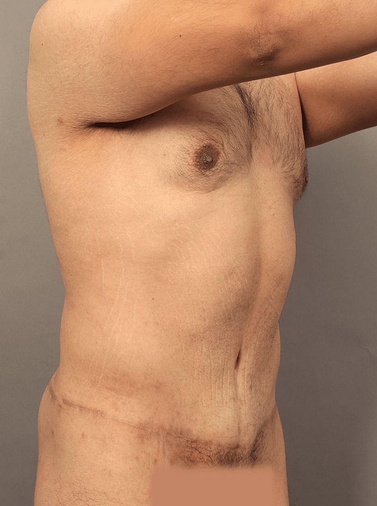 Liposuction Before & After