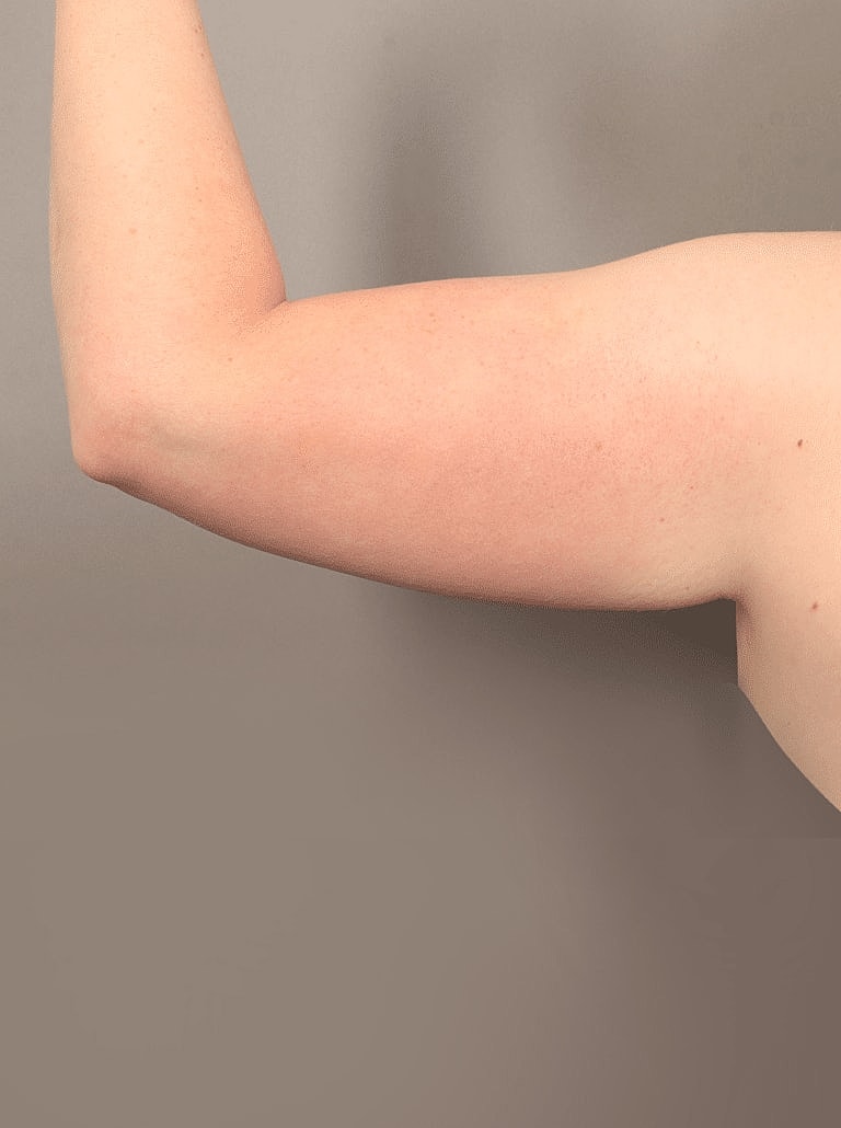 Liposuction Before & After