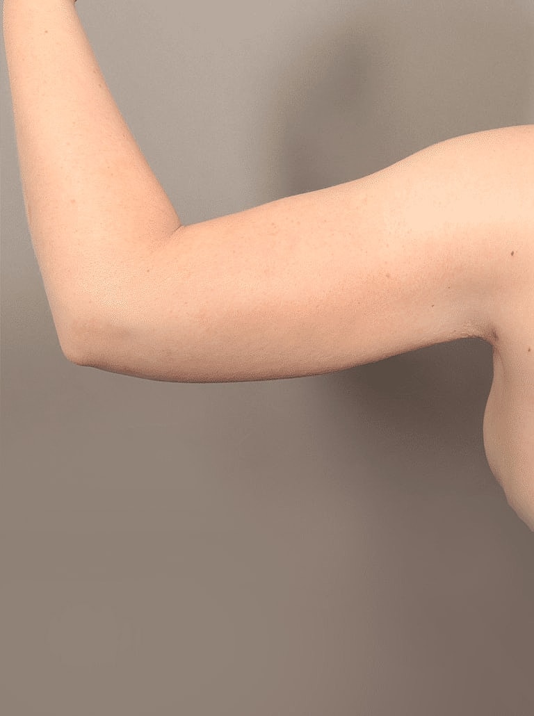 Liposuction Before & After