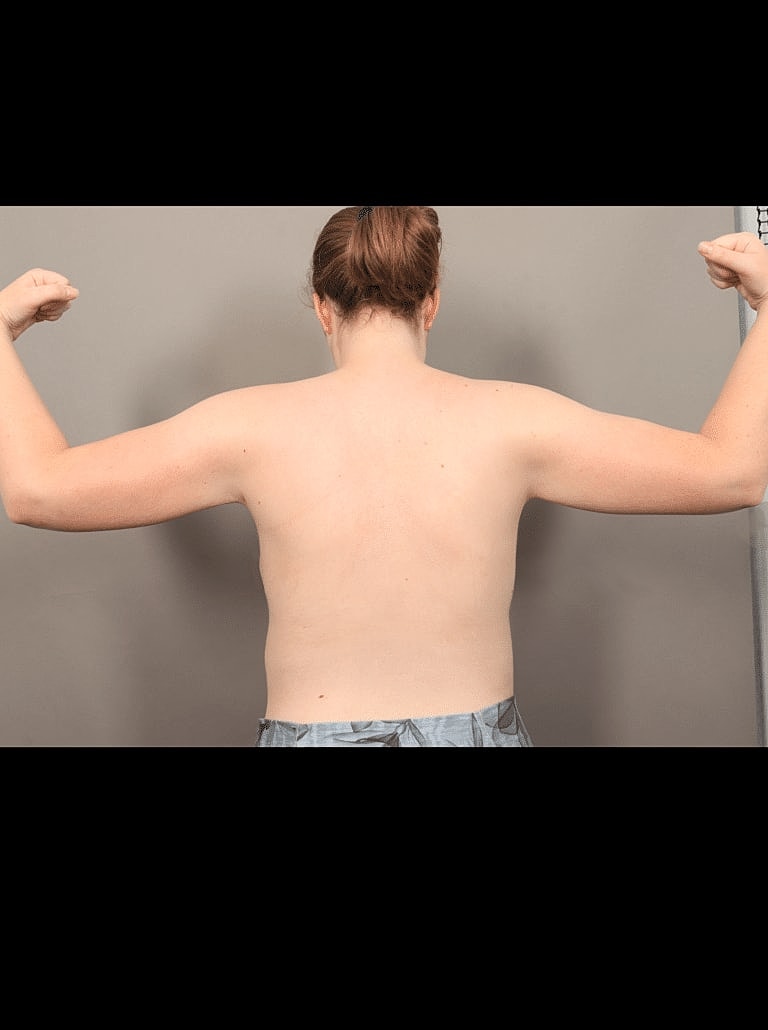 Liposuction Before & After