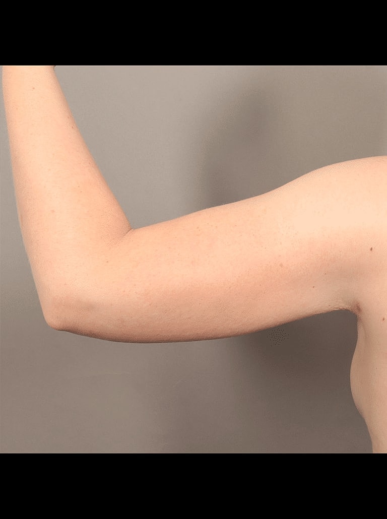 Liposuction Before & After