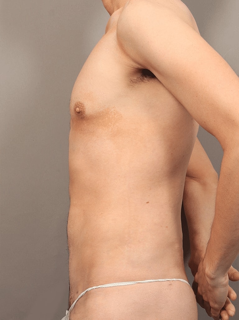 Liposuction Before & After