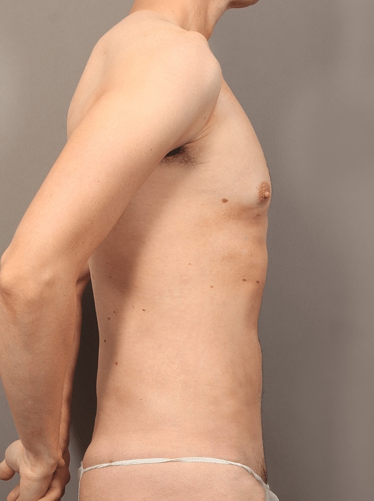 Liposuction Before & After