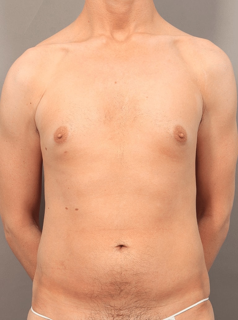 Liposuction Before & After