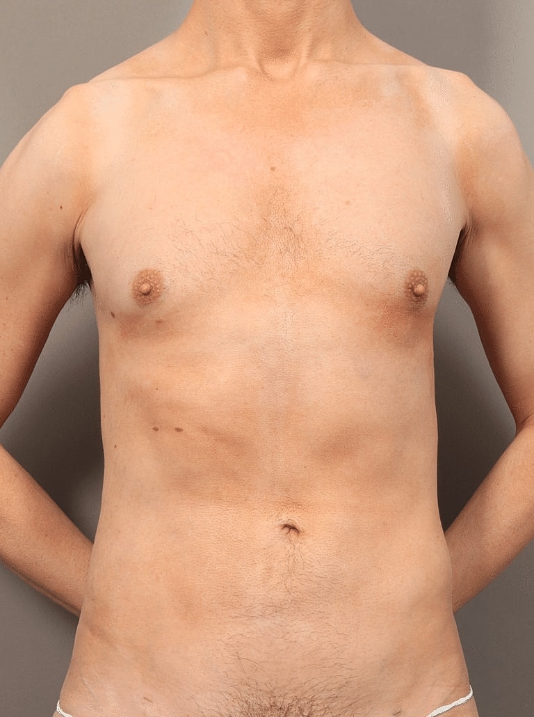Liposuction Before & After