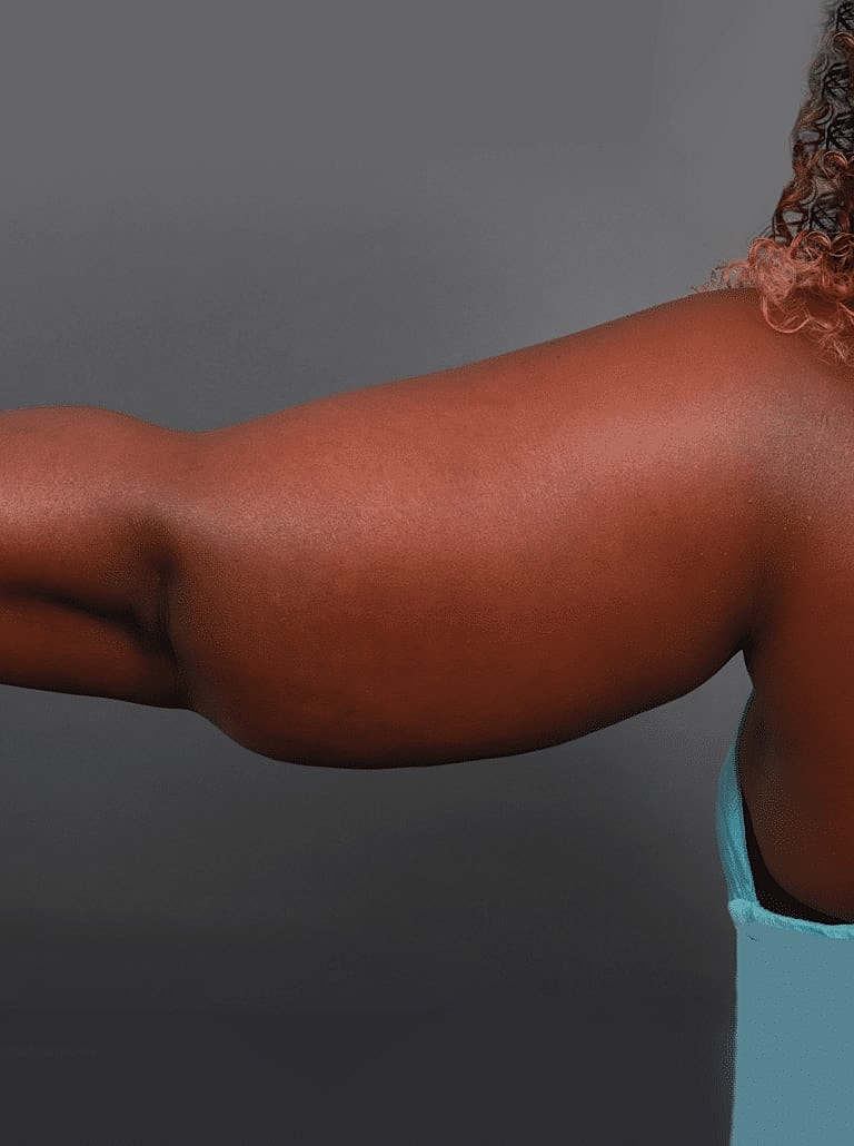 Liposuction Before & After