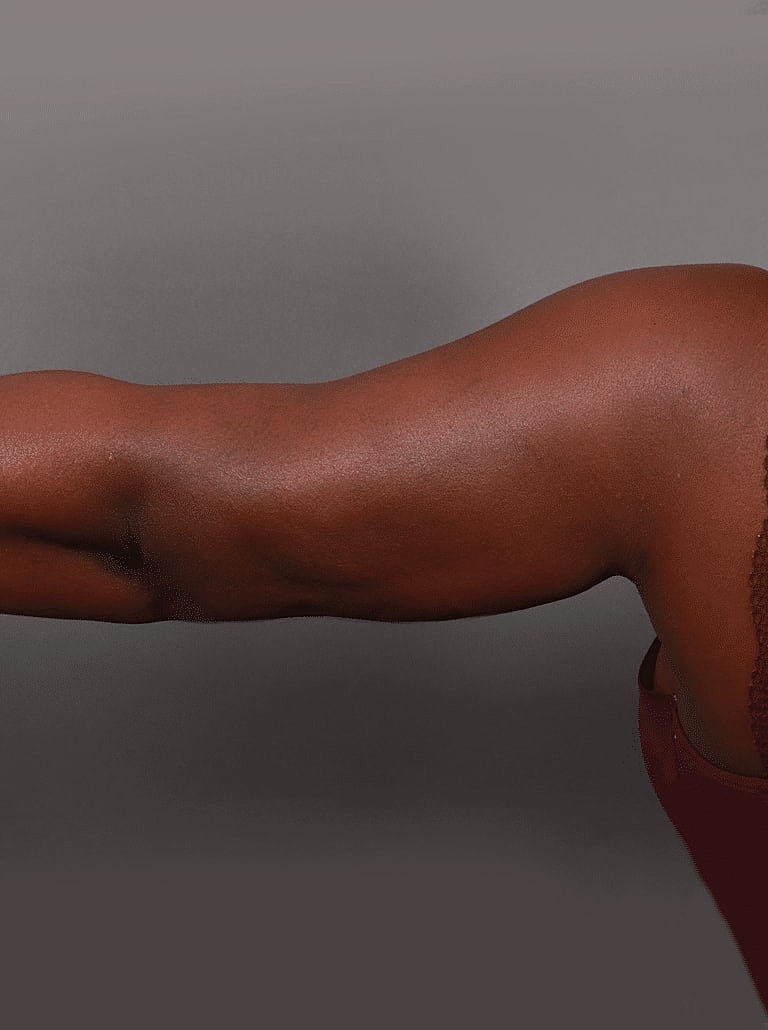 Liposuction Before & After