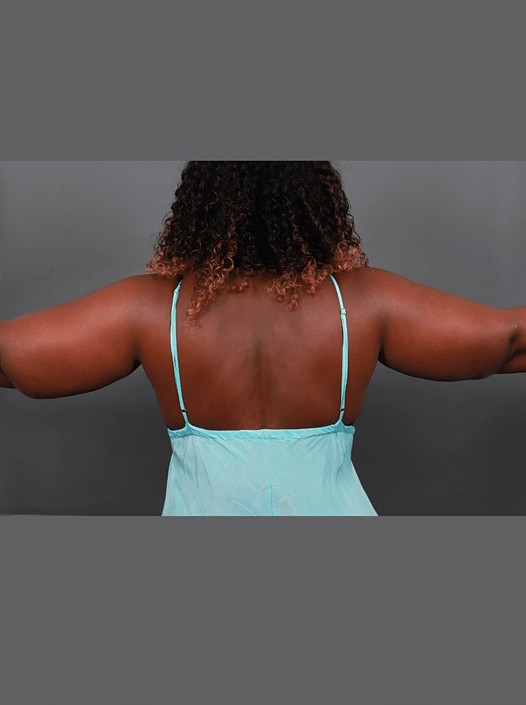 Liposuction Before & After