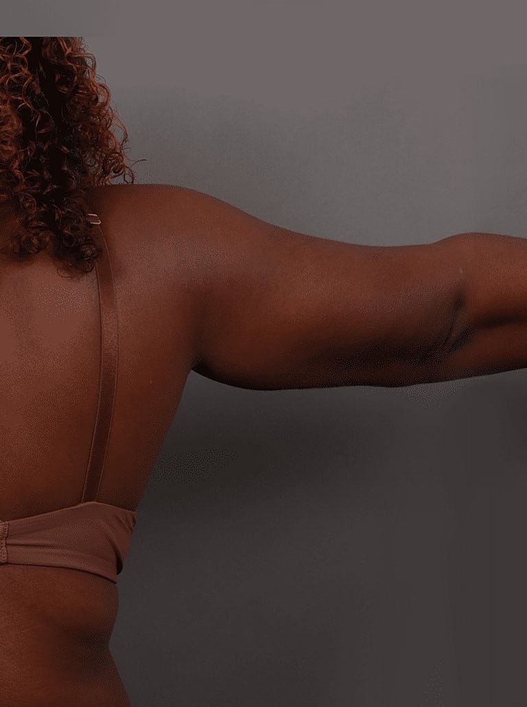 Liposuction Before & After