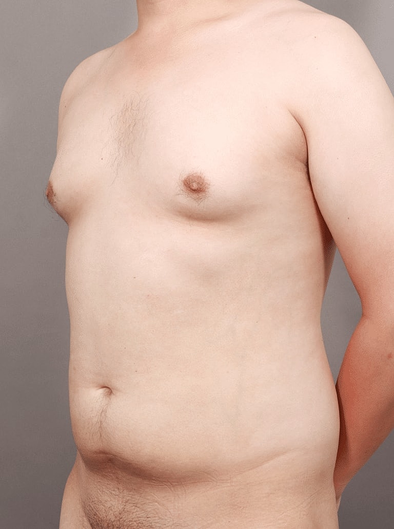 Liposuction Before & After