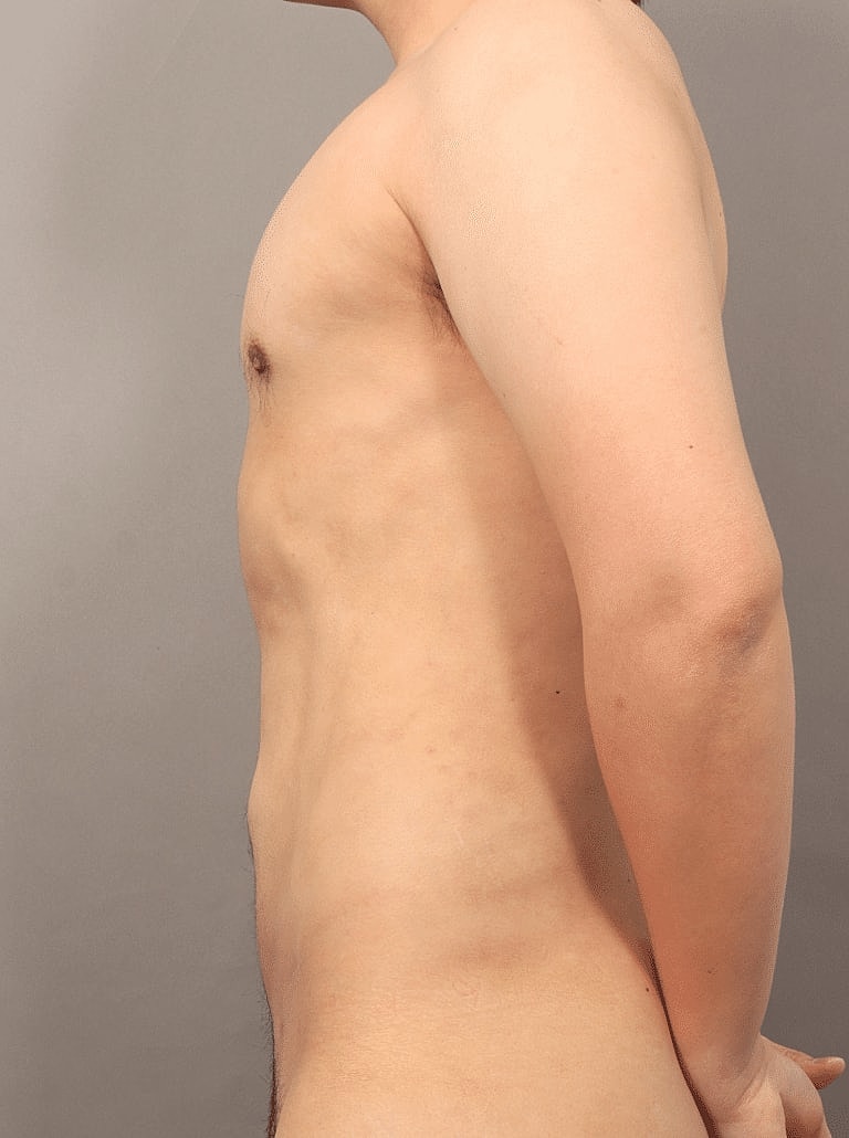 Liposuction Before & After