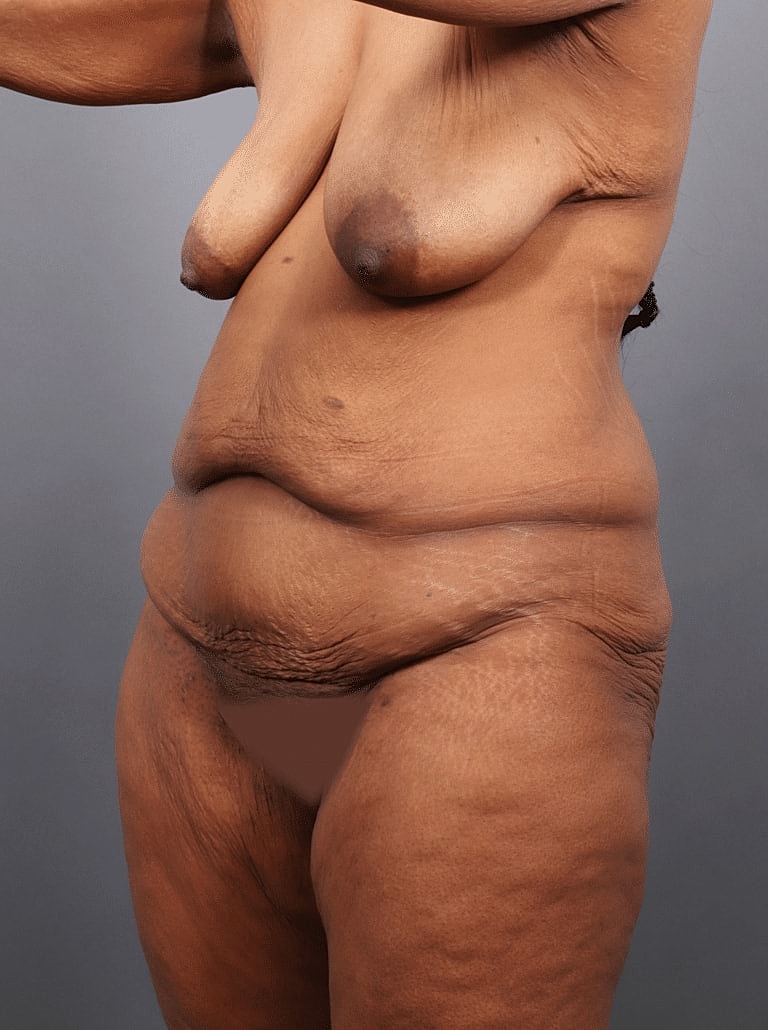 Liposuction Before & After