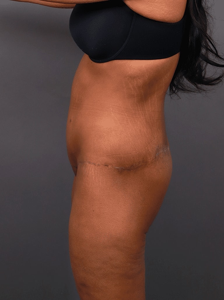 Liposuction Before & After