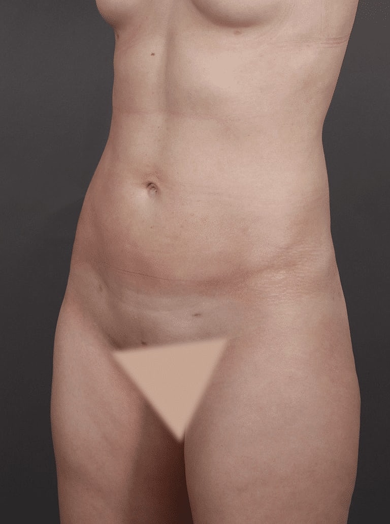 Liposuction Before & After