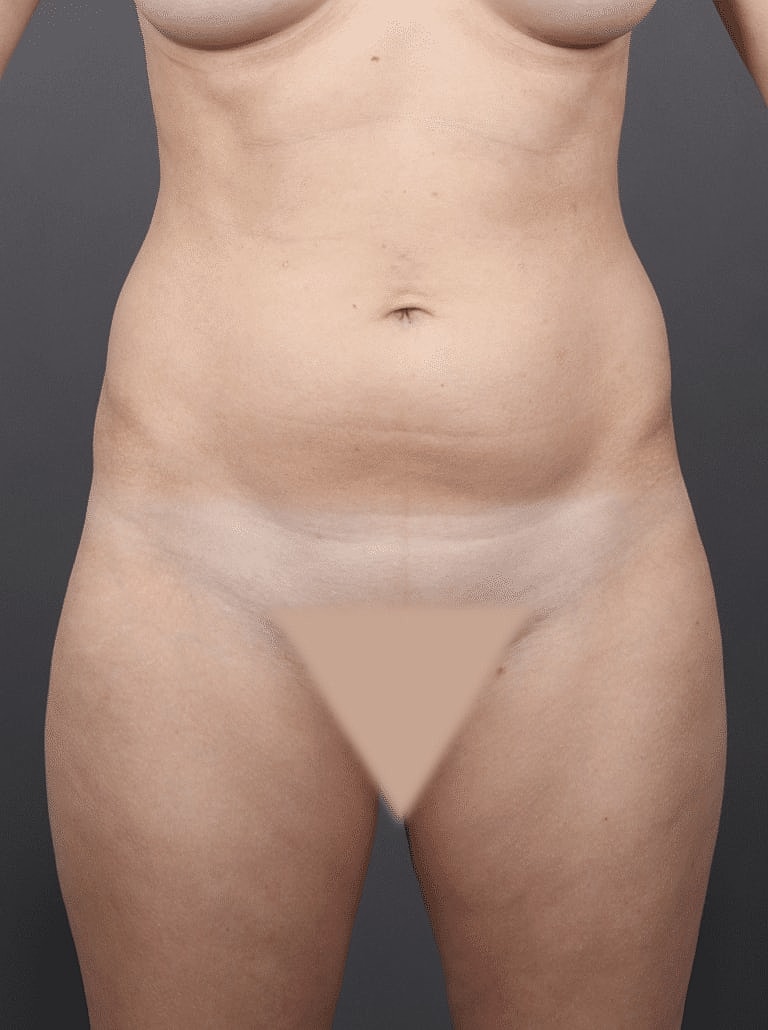 Liposuction Before & After