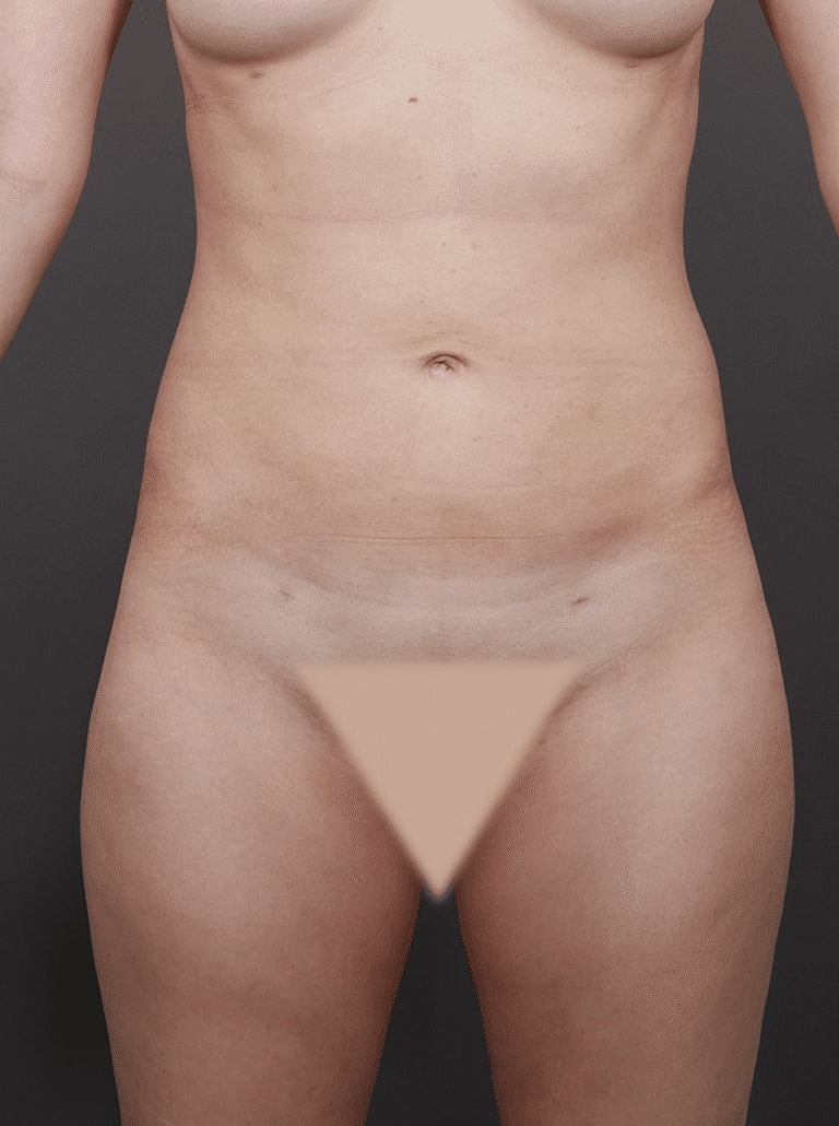 Liposuction Before & After