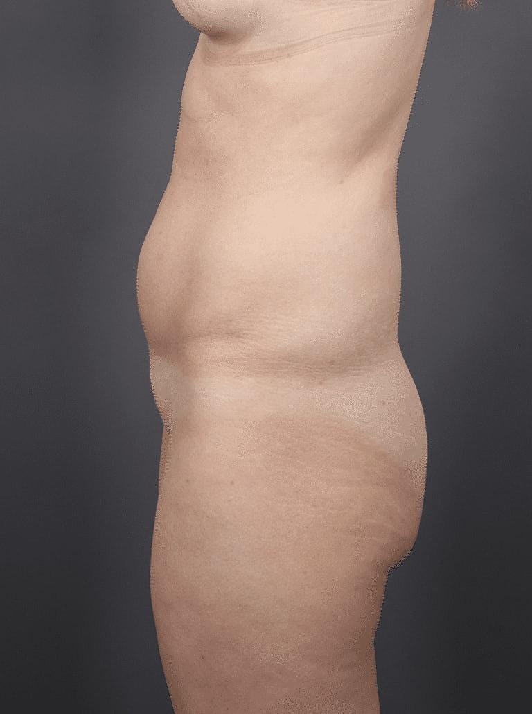 Liposuction Before & After