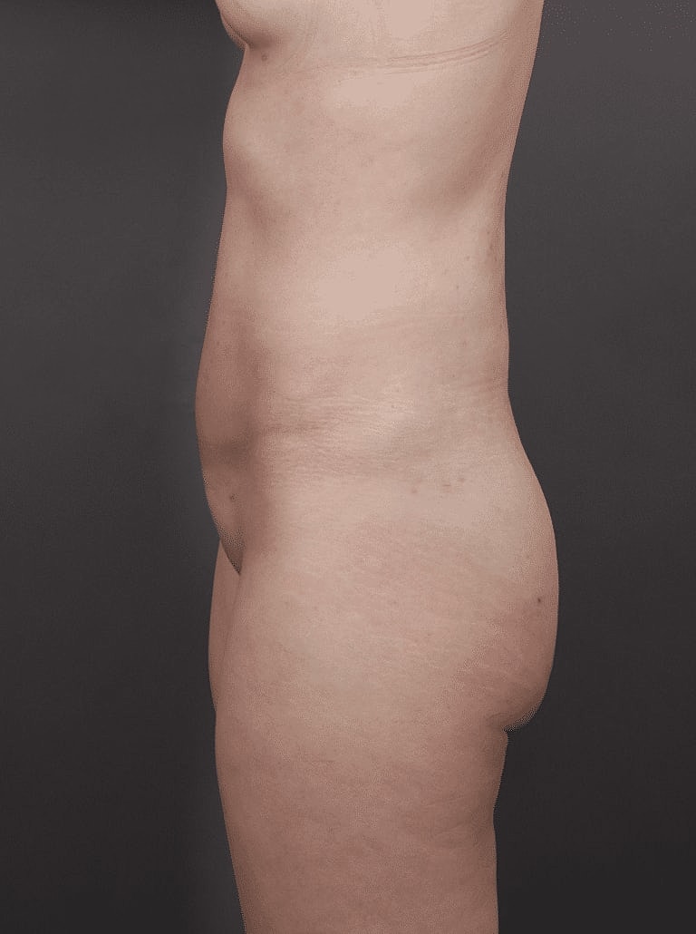 Liposuction Before & After