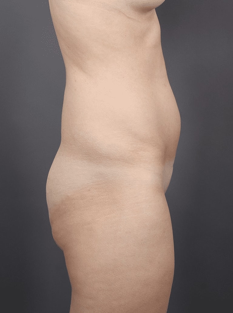 Liposuction Before & After