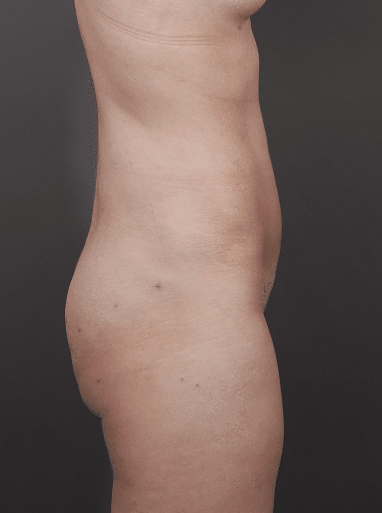 Liposuction Before & After