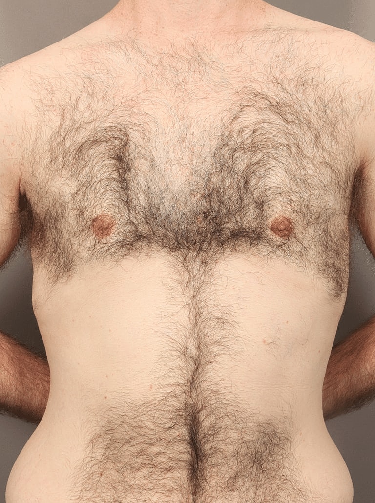 Liposuction Before & After